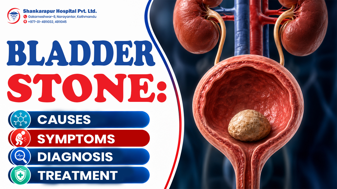 Bladder Stone: Causes, Symptoms, Diagnosis and Treatment